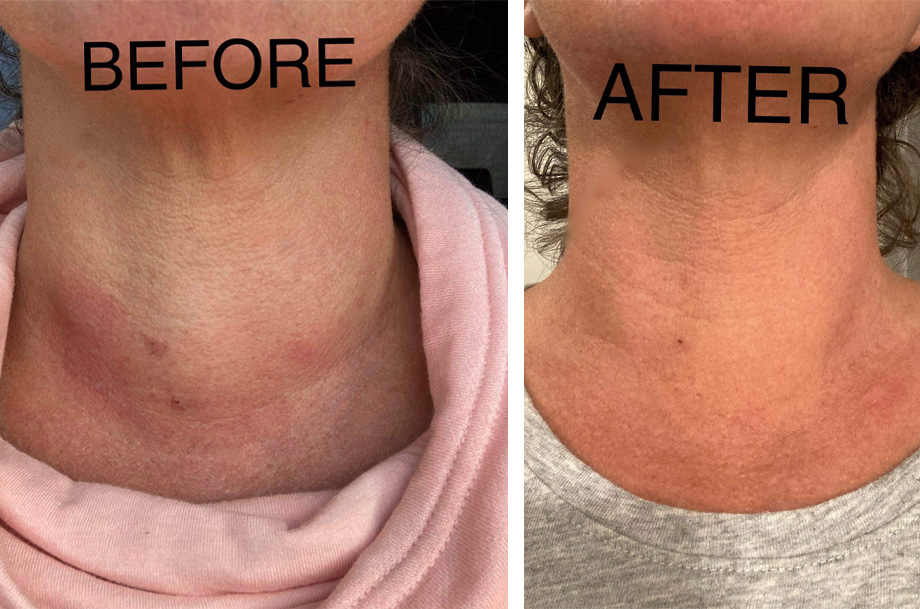 Side-by-side images of patient’s neck; the left one with noticeable swelling in the neck, the right one with no swelling