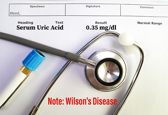 Piece of paper that says Serum Uric Acid 0.35 ml/dl with stethoscope and vial laying on top.