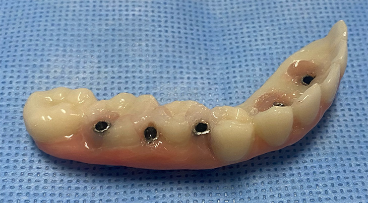 Dental prosthetic with fake teeth and hole for screws