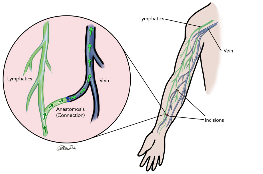 Diagram showing veins and lymphatic vessels in the arm