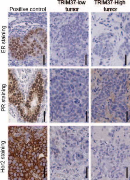 Nine multi-colored slide images representing breast cancer tissue.