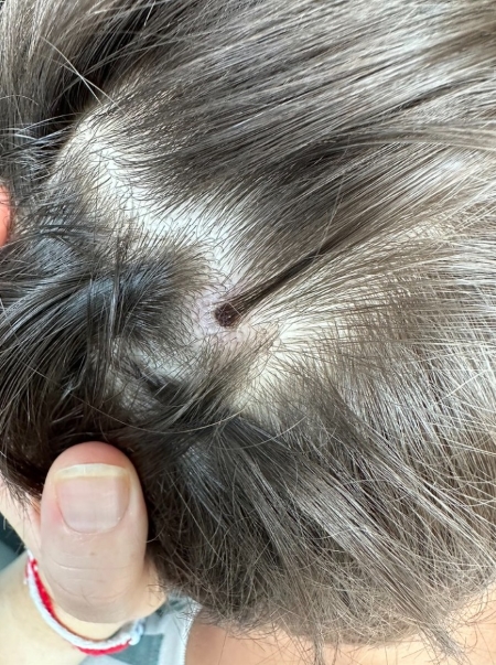 A small dark scab on a child’s scalp amid dark hair