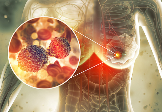 Female breast anatomy showing cancer cells