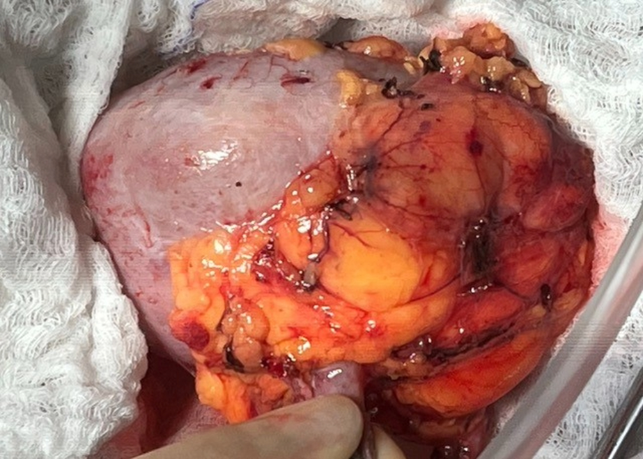 Human kidney removed from body surrounded by white gauze. 