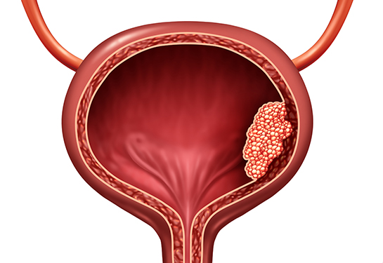 Imagen en forma de globo de vejiga y tracto urinario con tumor canceroso agrupadas a lado derecho de pared muscular de vejiga 