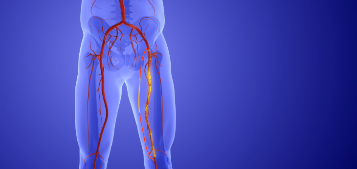Animation of peripheral artery bypass surgery 3d illustration.