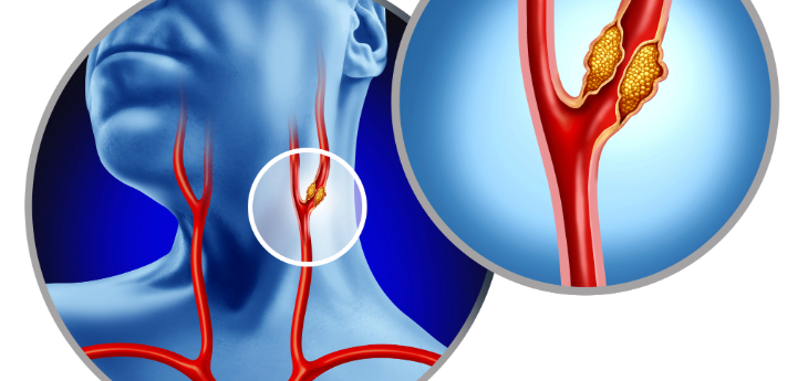 Illustration of carotid artery that shows plaque buildup inside the blocked vessel causing narrowing or stenosis.