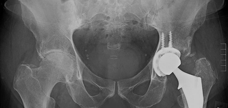 An Xray of a man getting a hip replacement