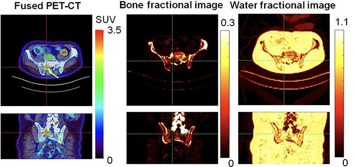 Three rows of colorful image pairs grouped by headings: “Fused PET-CT”, “Bone fractional image” and “Water fractional image.”