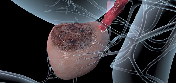 3D medical illustration of prostate cancer