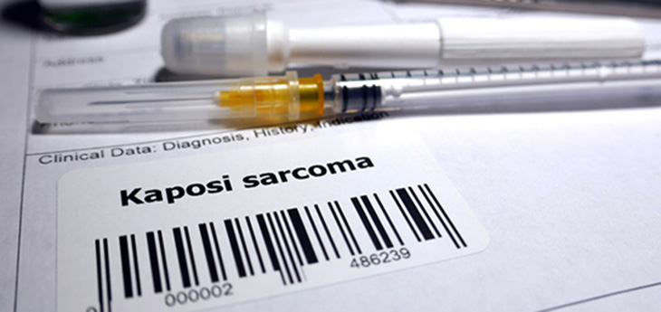 Request for biopsy Kaposi's sarcoma