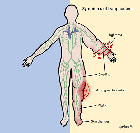 Body diagram showing words with lymphedema symptoms, including tightness, swelling, discomfort, pitting, and skin changes on limbs
