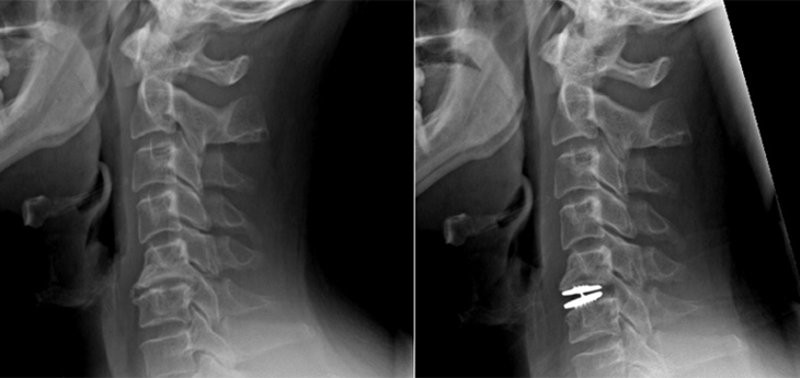 Two X-rays of Mark Bates’ neck before and after surgery.