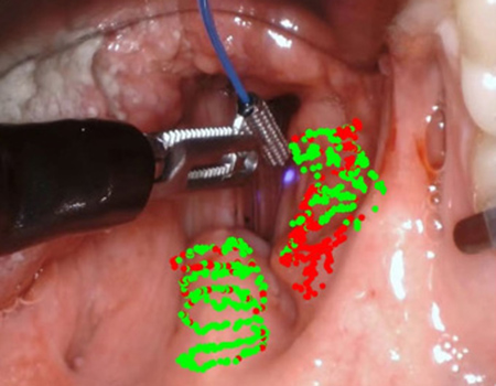 FLIm technology integrated to TORS to detect cancerous tissues