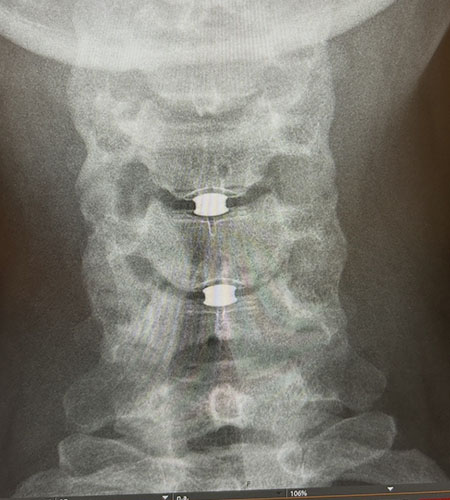 A scan of a woman's spine showing spinal implants. 