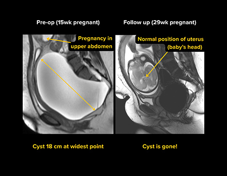 Three MRI images of a woman&rsquo;s pregnant abdomen