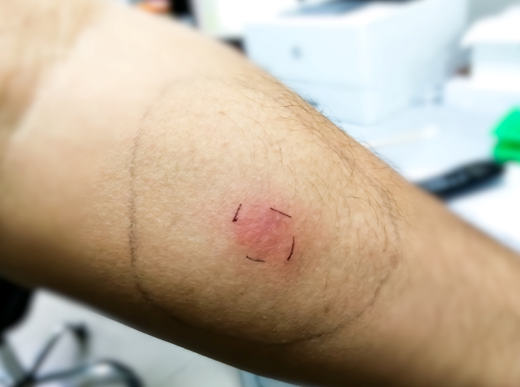 Close-up photo of patient&rsquo;s arm with ink marks next to a raised red spot on the skin and a larger, circled ink mark.