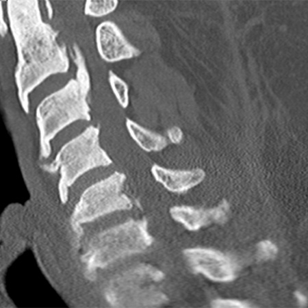 Side view of cervical spine CT showing a large OPLL at the upper part of the spine.