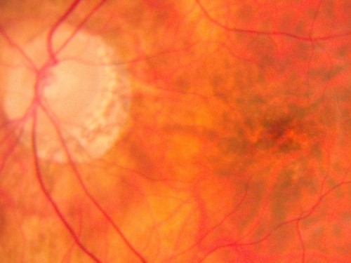 Close-up image of a human retina showing blood vessels, optic disc, and orange-red retinal tissue.