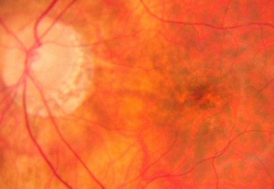Close-up image of a human retina showing blood vessels, optic disc, and orange-red retinal tissue.