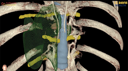 3D rendering of human spine, in white, with translucent green outline of cyst volume.