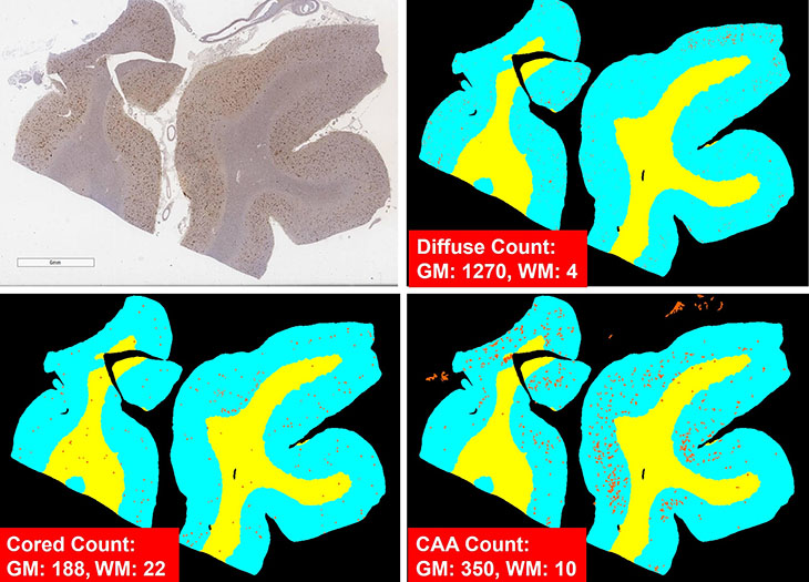 Four stained slide images of human brain, one in gray and white, three in yellow and light blue, text says "diffuse count: GM 1270, WM: 4, Cored Count: GM 188, WM: 22, CAA Count: GM 350, WM:10