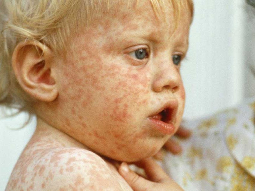 child with measles rash