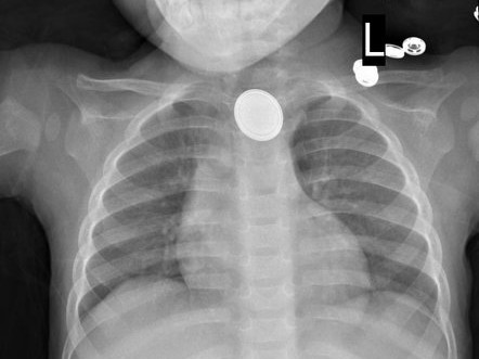 x-ray with battery or coin