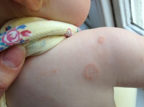 child with ring worm on back