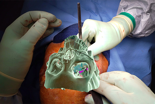 Augmented reality overlay during surgery 