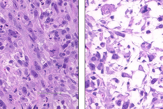 Sarcoma 