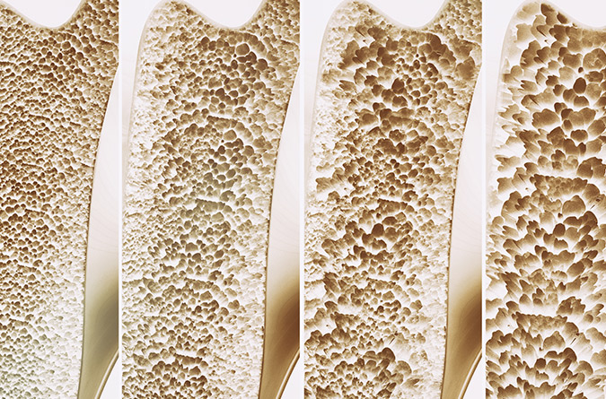 Bone loss illustration