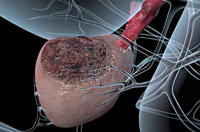 Digital graphic showing prostate cancer. 