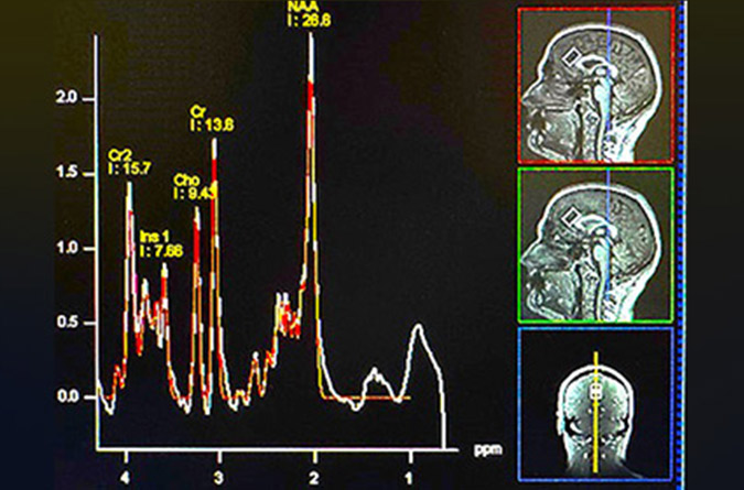 A non-invasive imaging technique, 1H-MRS.