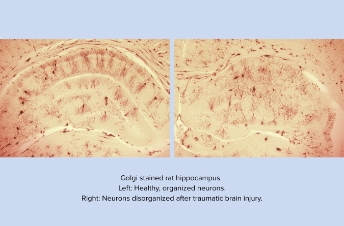 Golgi stained rat hippocampus. Left: Healthy, organized neurons. Right: Neurons disorganized after traumatic brain injury.
