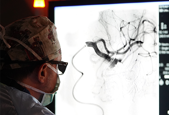 CNS Endovascular Surgery