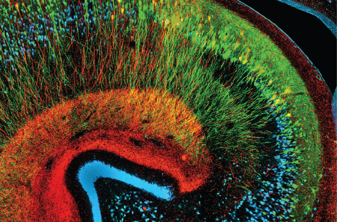 Two different markers for dying neurons (green and red) can be seen accumulating phospho-tau, in contrast to healthy neurons (blue)