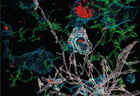 Glial cells attacking SARS-CoV-2 Infected Neurons