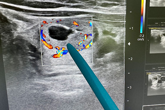 Ultrasound image with doctor pointing at image with pen, black and white ultrasound with colored areas 