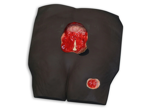 "Stan" Stage IV Pressure Ulcer Model