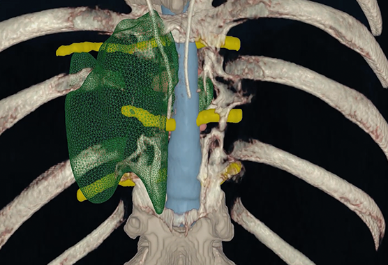 3d model of a spine and tumor
