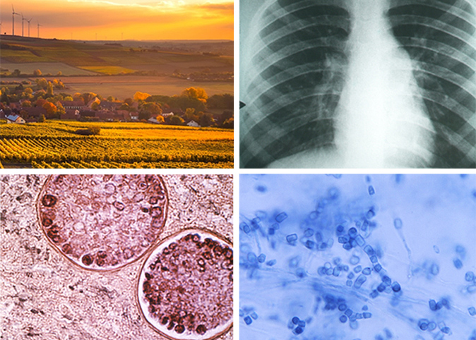 Four images related to Valley Fever.