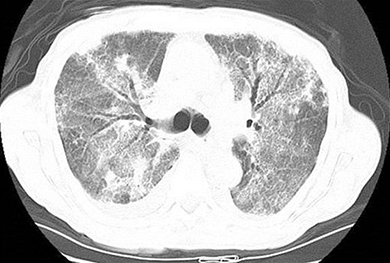 An x-ray of a cross section of lungs.