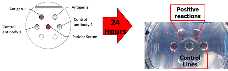 Illustration of a timeline outlining a ‘typical’ Valley Fever disease course.