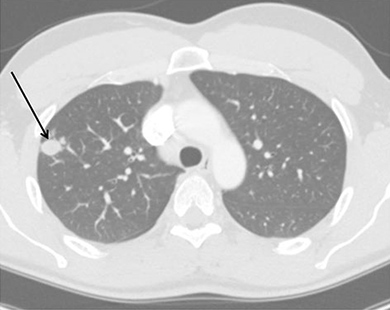 An x-ray of a cross section of lungs.