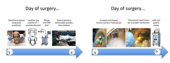 preparation for DBS surgery