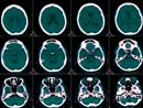 MRI brain scans