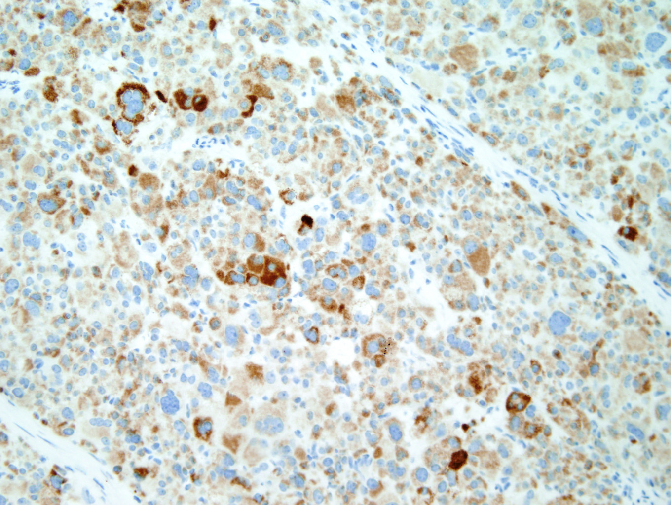 COTM Mar2010 Immunohistochemical Stains: Melan-A