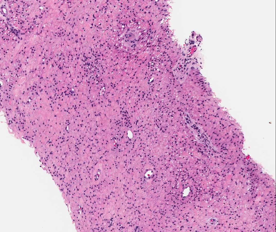 Case of the Month, Aug. 2012: Microscopic images - Figure 3