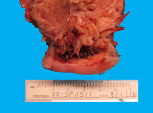 Case of the Month, Sept. 2012: Microscopic images - Figure 3